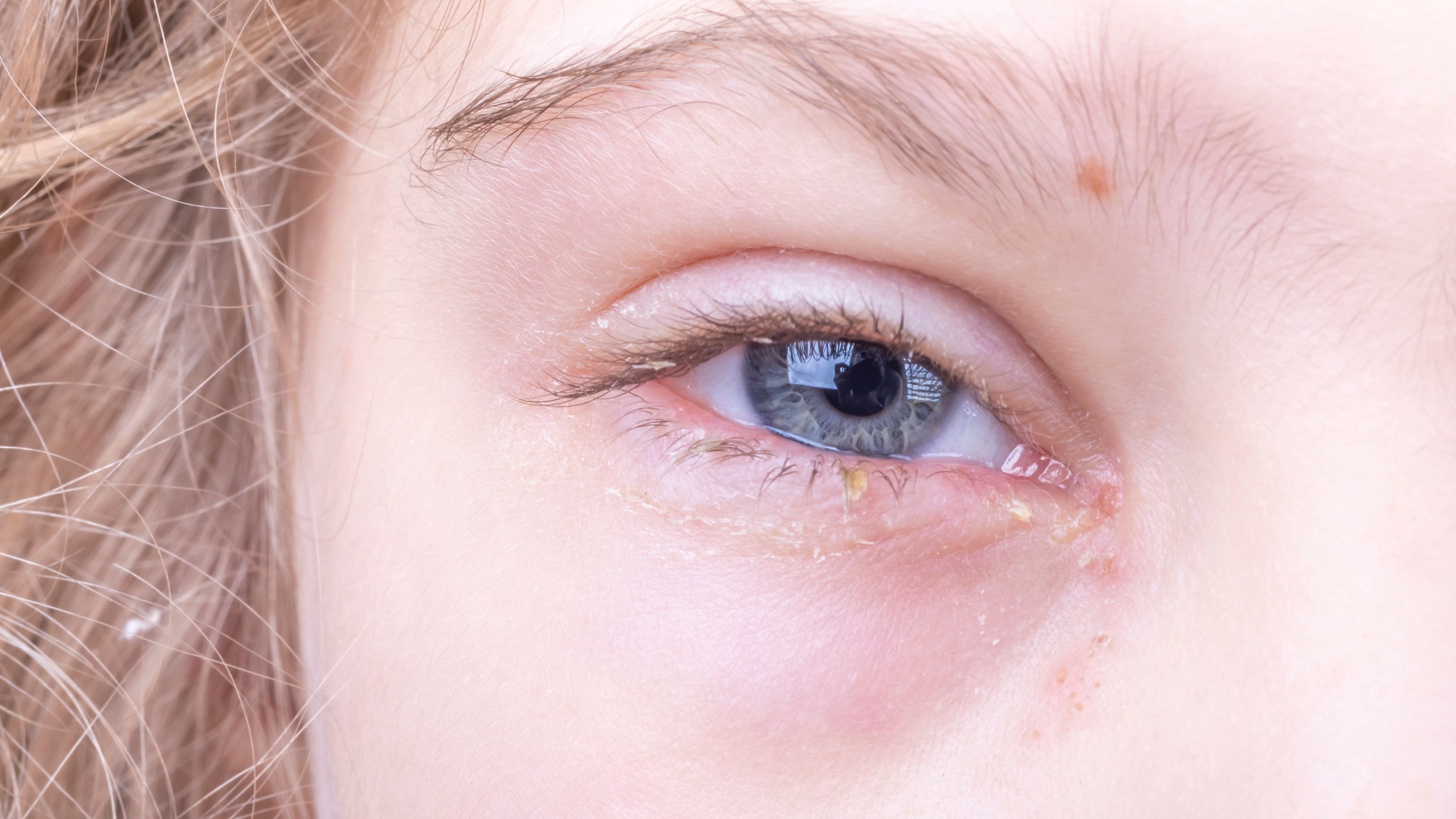 young girl with eye discharge