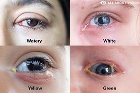 closeups of the different types of eye discharge: watery, white discharge, yellow discharge and green discharge