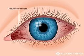 illustration of red eyes (inflamed and irritated sclera)