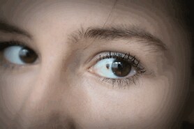 closeup of a woman's eye with ocular melanoma