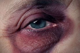 closeup of a black eye