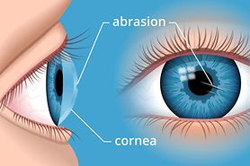 Illustration of a corneal abrasion
