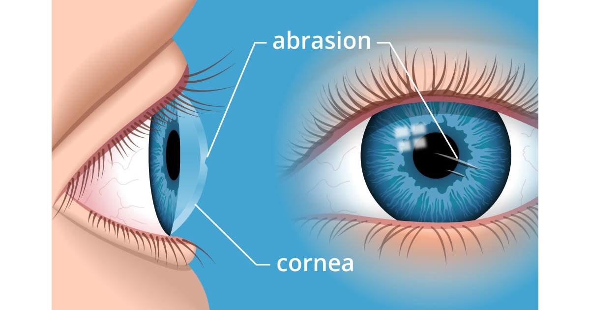 Illustration of a corneal abrasion Illustration of a corneal abrasion