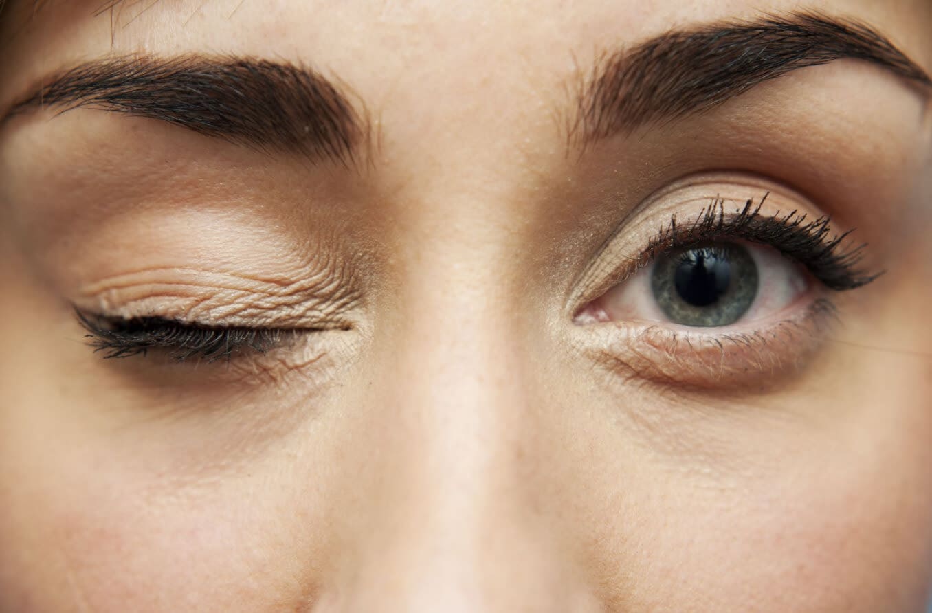 Depiction of person with apraxia of eyelid Depiction of person with apraxia of eyelid