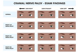 Cranial nerve palsy exam findings examples