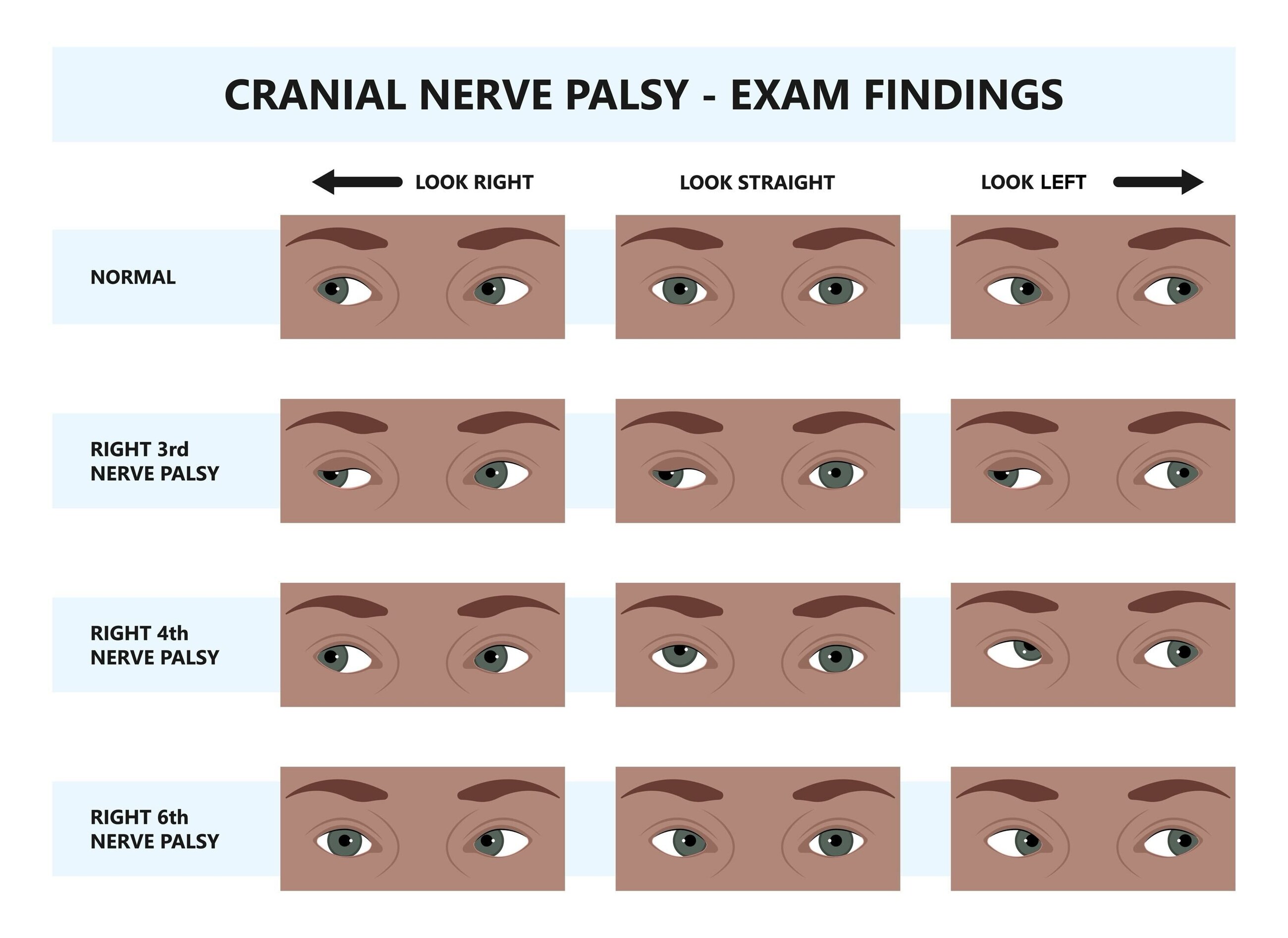 Cranial nerve palsy exam findings examples Cranial nerve palsy exam findings examples