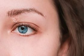 girl with psoriasis on upper eyelid