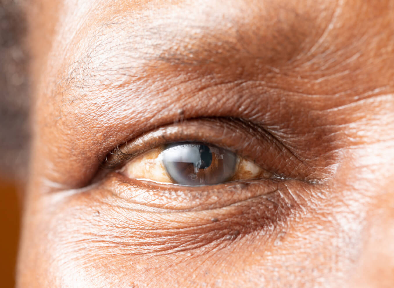 Depiction of a person with floppy iris syndrome