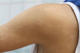 A visual case of a linear epidermal nevus in a child.