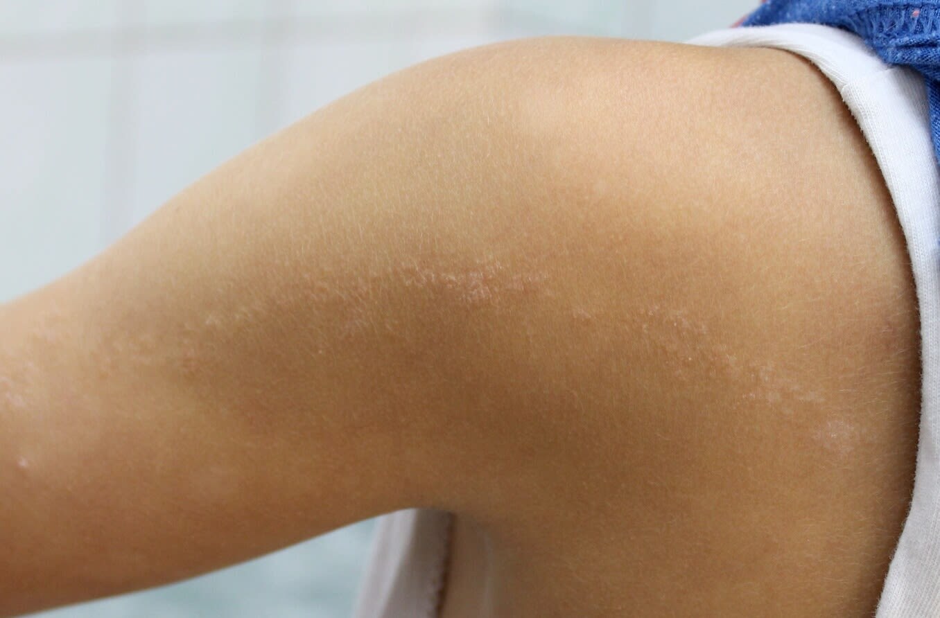 A visual case of a linear epidermal nevus in a child.
