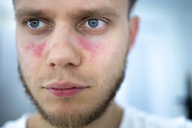 Depiction of systemic lupus erythematosus and its effect around the eyes