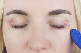 closeup of a woman with ocular rosacea