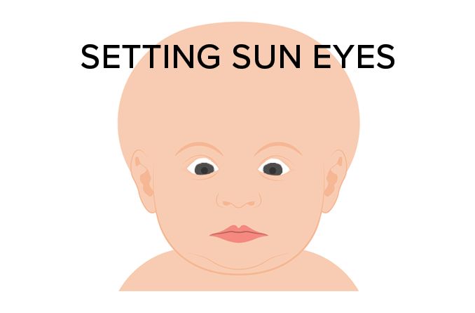 illustration of an infant with setting sun eyes illustration of an infant with setting sun eyes