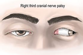 The clinical presentation of right third cranial nerve lesion