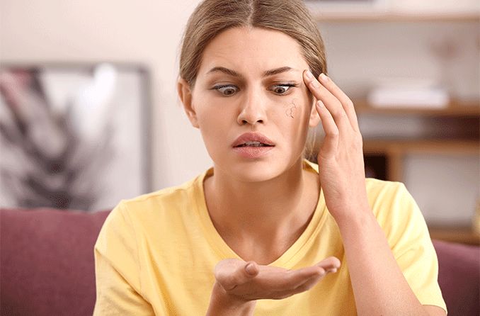 woman with madarosis (eyelash and eyebrow loss)
