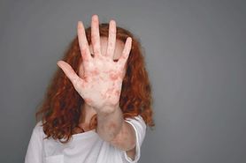 woman with measles putting her hand up to block her face and eyes