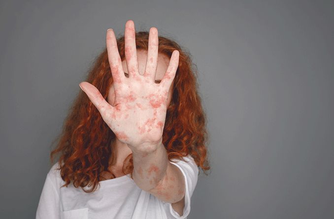woman with measles putting her hand up to block her face and eyes woman with measles putting her hand up to block her face and eyes