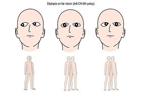 illustration of eyes with sixth nerve palsy which causes double vision