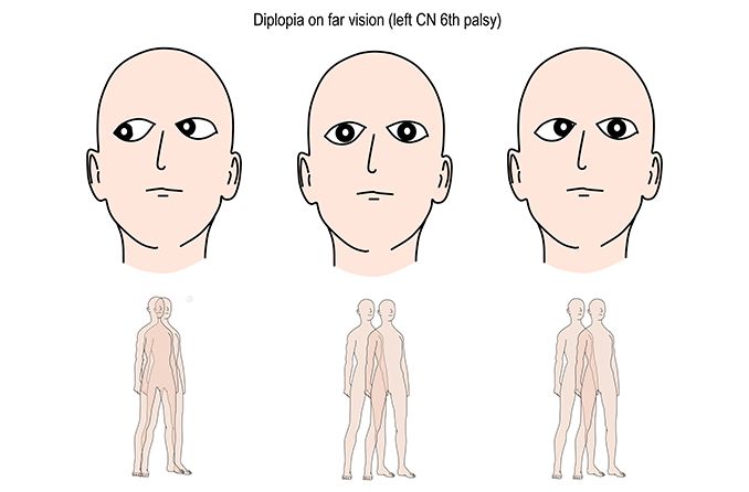 illustration of eyes with sixth nerve palsy which causes double vision