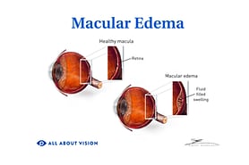 Healthy macula v macular edema.