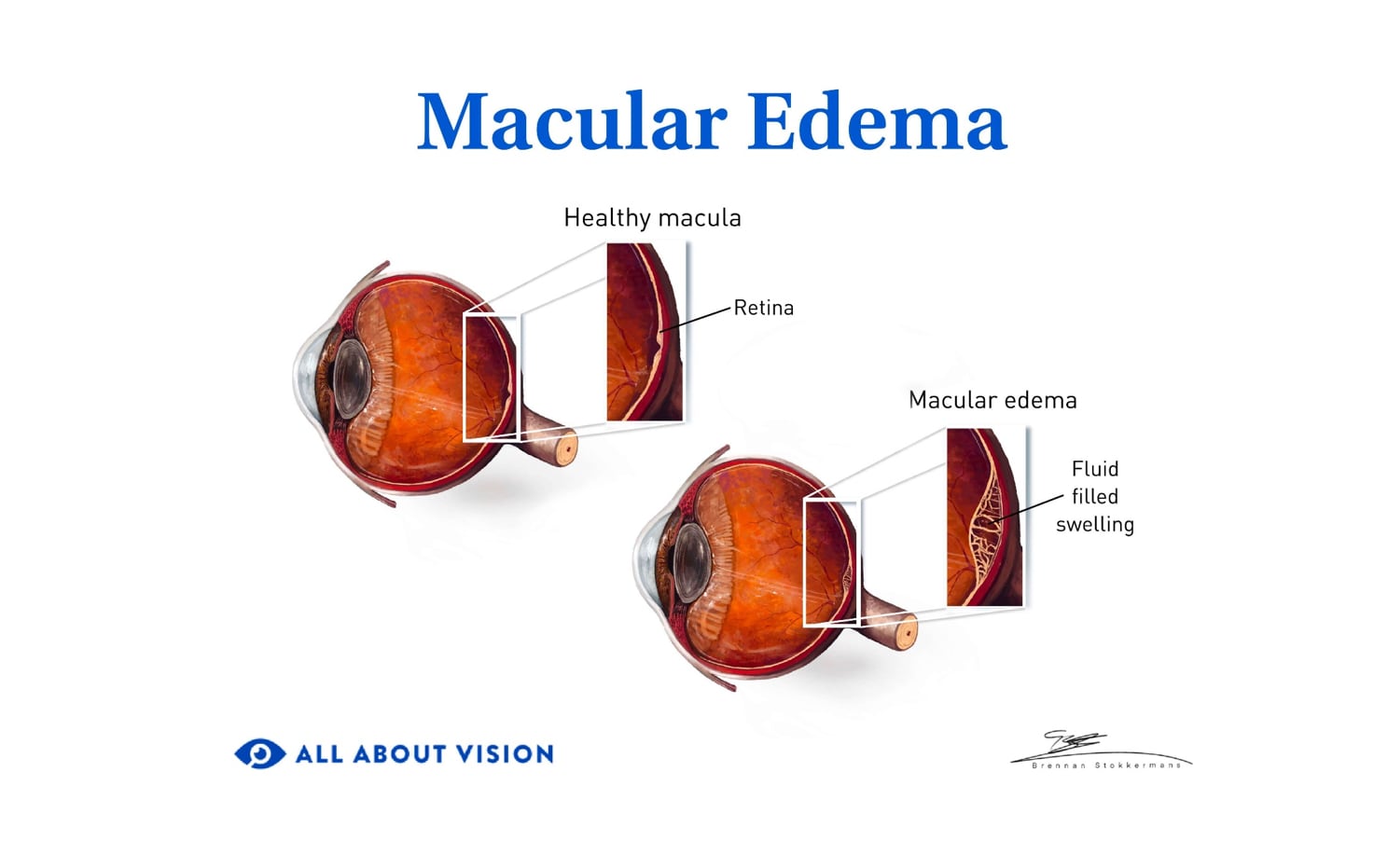 Healthy macula v macular edema.