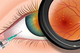 eye injection of lucentis or avastin
