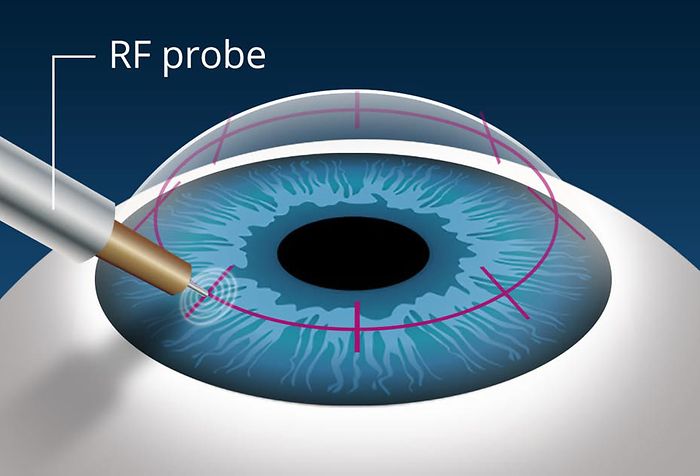 Vision surgery for presbyopia