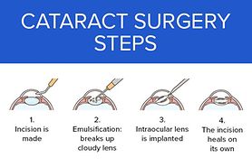 illustration of the four main steps in cataract surgery