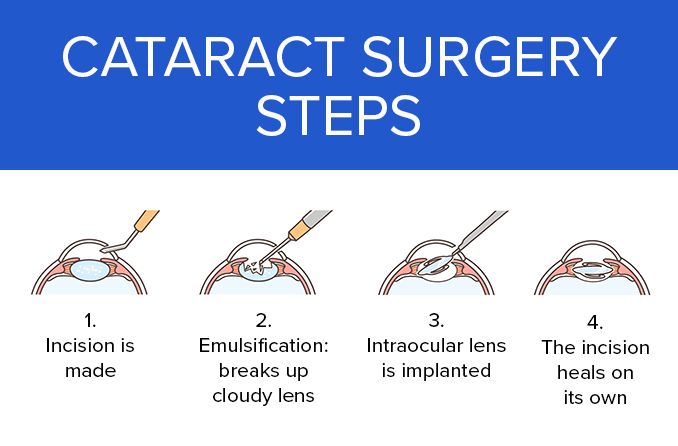 illustration of the four main steps in cataract surgery