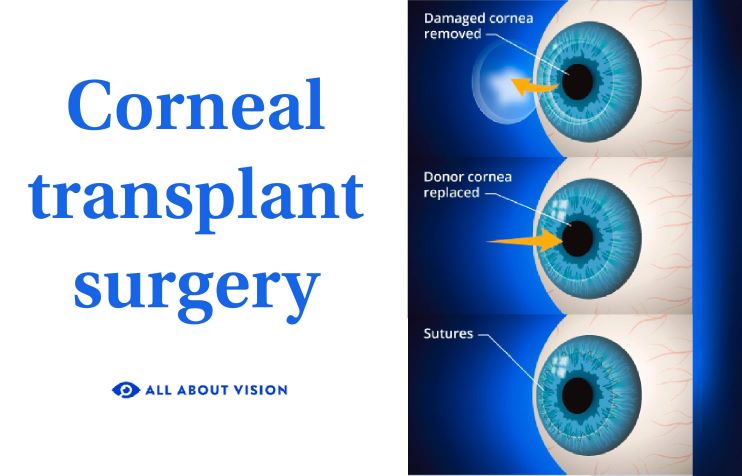 cornea transplant illustration