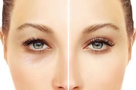 upper and lower eyelid blepharoplasty before and after pics