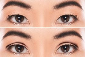closeup of a set of asian eyes before and after undergoing double eyelid surgery