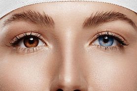 woman with an eye color change surgery with one blue eye and one brown eye