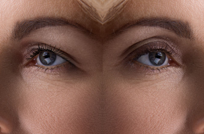 before and after side by side image of eyelid surgery