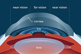 PresbyLASIK: LASIK for presbyopia correction PresbyLASIK: LASIK for presbyopia correction