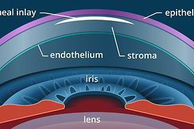 Presbyopia Surgery Presbyopia Surgery