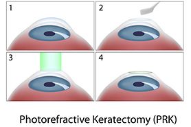 illustration of how prk laser surgery works