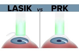 illustration of a lasik surgery procedure vs a prk laser surgery procedure