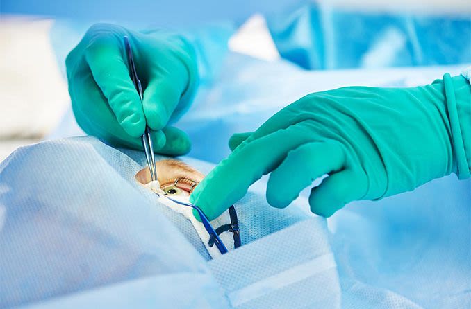 Refractive lens exchange (lens replacement surgery)