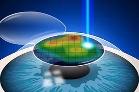 Custom Wavefront LASIK: Personalized vision correction Custom Wavefront LASIK: Personalized vision correction