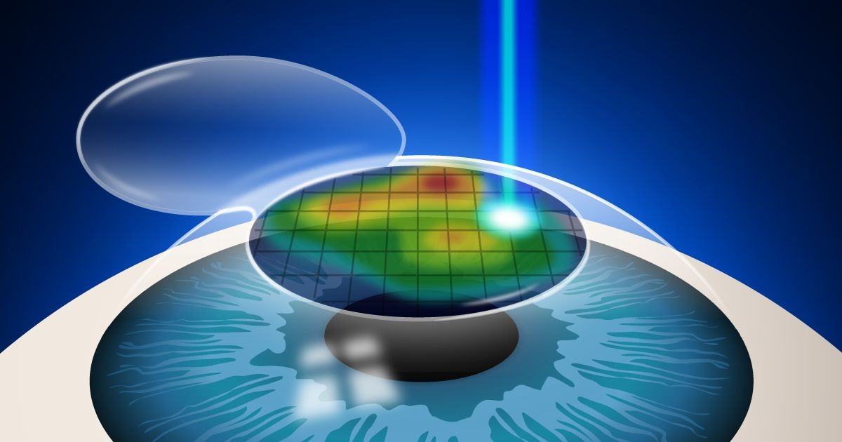 Custom wavefront lasik Custom wavefront lasik