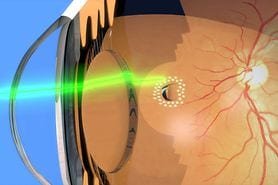 Depiction of laser photocoagulation around retinal tear