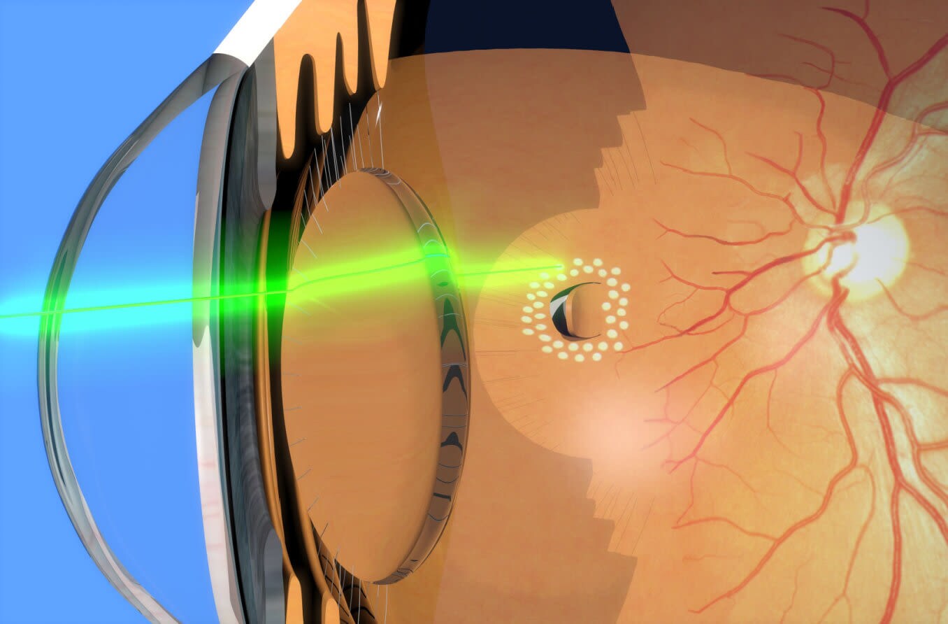 Depiction of laser photocoagulation around retinal tear Depiction of laser photocoagulation around retinal tear