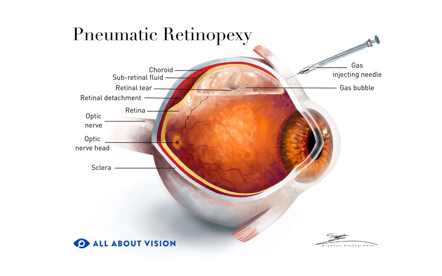 Image showcasing the anatomy of the eye, and what a detached retina looks like before pneumatic retinopexy surgery.