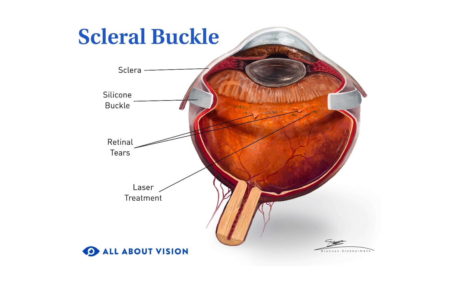 Illustration of elements that make up a scleral buckle
