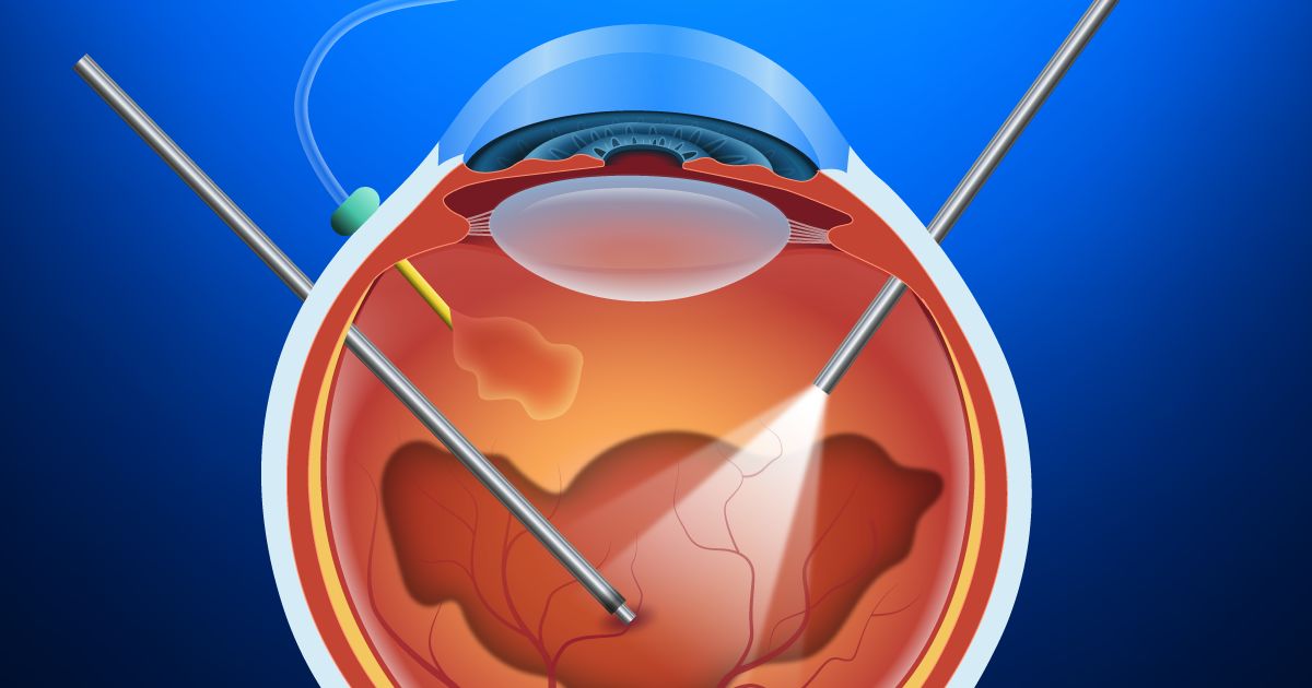 vitrectomy illustration vitrectomy illustration