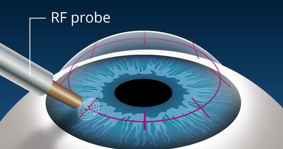 illustration of conductive keratoplasty (CK) procedure