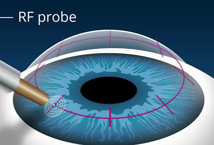 Conductive keratoplasty (CK) reduces need for reading glasses