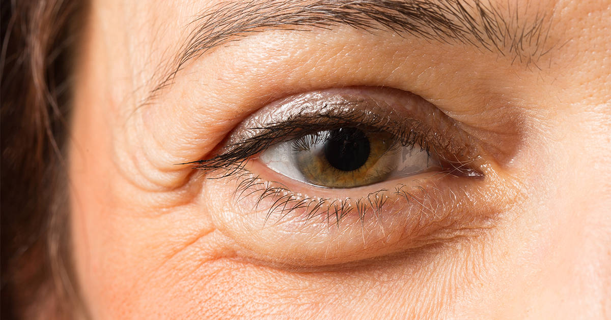 Geschwollene Augen: Wie man angeschwollene Augen loswird