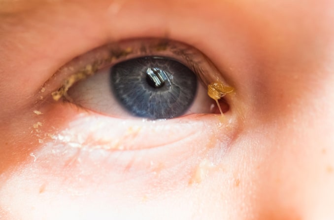 Verklebtes Auge mit gelbem Schleim